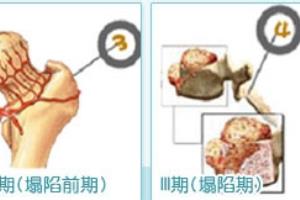 股骨头坏死早期应如何治疗.