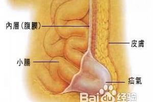 疝气应该怎么治疗.